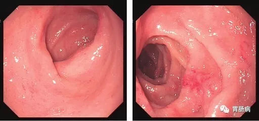 萎縮性胃炎不可怕，只要真正了解它