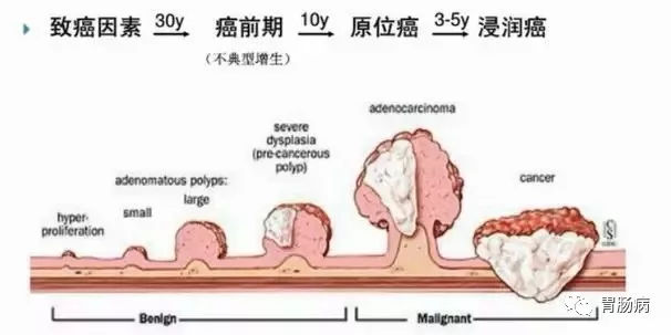 體檢查出腸息肉一定要切除！ 95%腸癌由它演變而來