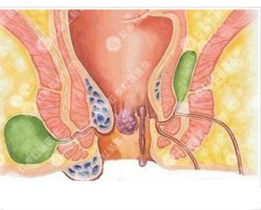 南寧哪個醫(yī)院可以做肛周膿腫？